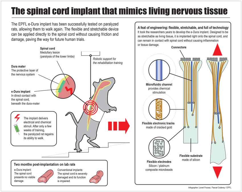 The unique implant is able ti sit directly on the spinal cord or brain.