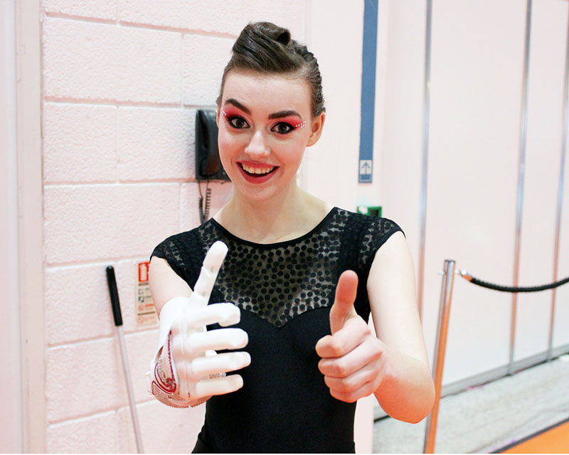 Openbionics_Grace_Mandeville_prosthetic_arm_hand_4