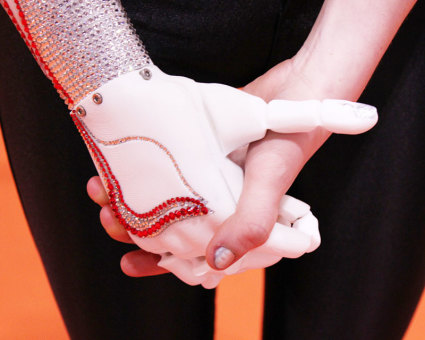 Openbionics_grace_mandeville_prosthetic_arm_hand_5