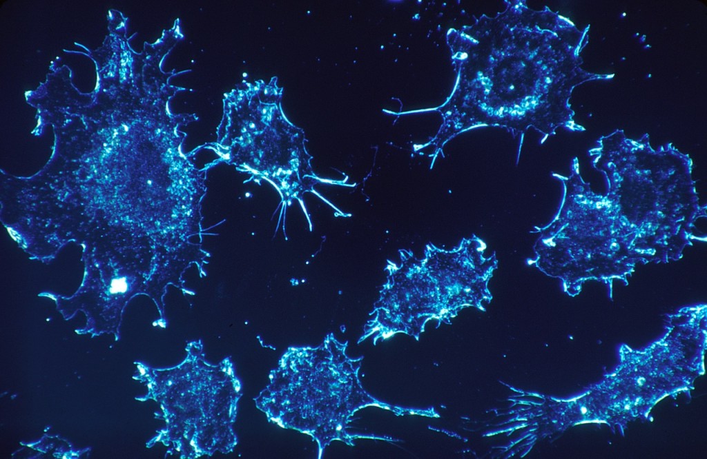 Cancer cells. Credit: CCO public domain
